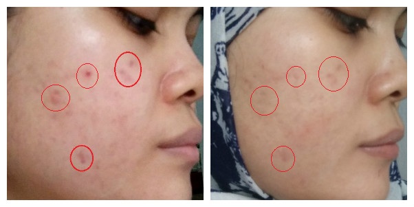 cara-pemakaian-tretinoin-hasil-before-after-featured
