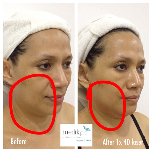 Laser 4D Treatment Before-After 1