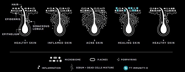 2 Produk Skincare Drugstore untuk Mengatasi Jerawat