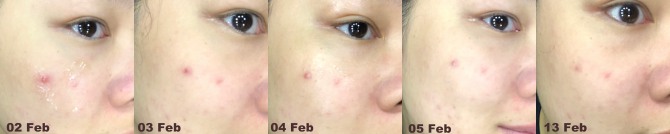 review progress Tisha AC7 acne