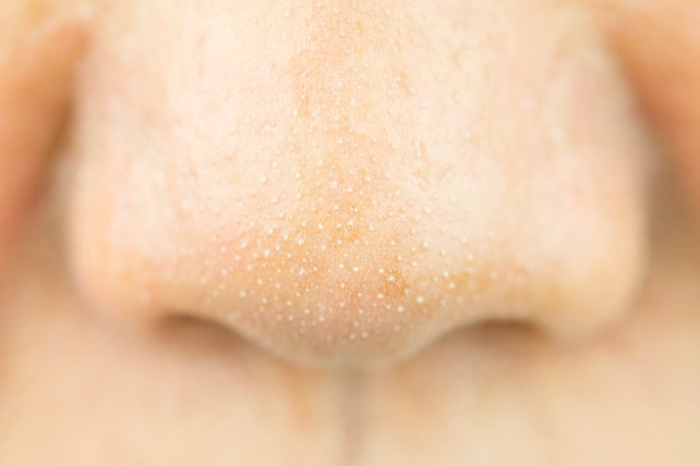 Close Up acne small pimple on nose. concept of beauty and health.
